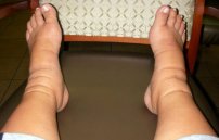 Отеки ног при онкологии почему проявляются, сколько осталось жить, как снять отек