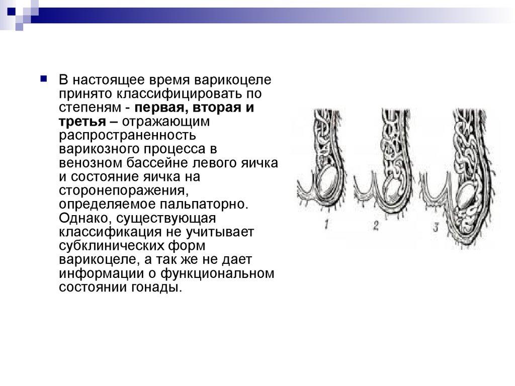 Варикоз Левое Яичко