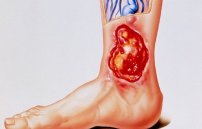 Как лечить трофические язвы на ногах при варикозе в домашних условиях?