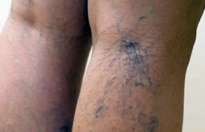Варикозные узлы на ногах: причины и лечение