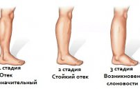 Лимфодренаж ног при варикозе