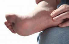 Вены на ступнях ног: симптомы и лечение