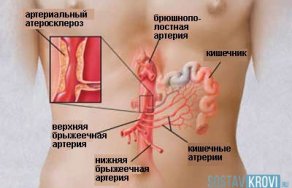 Как вовремя выявить мезентериальный тромбоз кишечника причины, симптомы и последствия