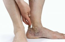 Симптомы закупорки вен на ногах и лечение в домашних условиях
