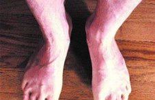 Лимфовенозная недостаточность ног