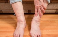 Отеки ног: причины и лечение у пожилых народными средствами