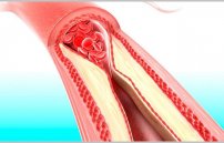 Симптомы и лечение тромба в ноге под коленом сзади