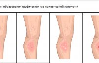 Лечение трофических язв на ногах