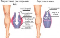 Лечение варикоза вен на ногах перекисью водорода