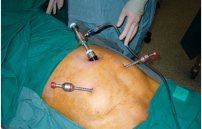 Лапароскопическая операция при варикоцеле