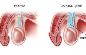 ЖИЗНЬ БЕЗ ЛЕКАРСТВЧто нельзя делать после операции варикоцеле