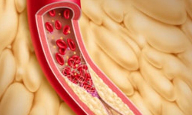 Тромбоэмболия бедренной артерии