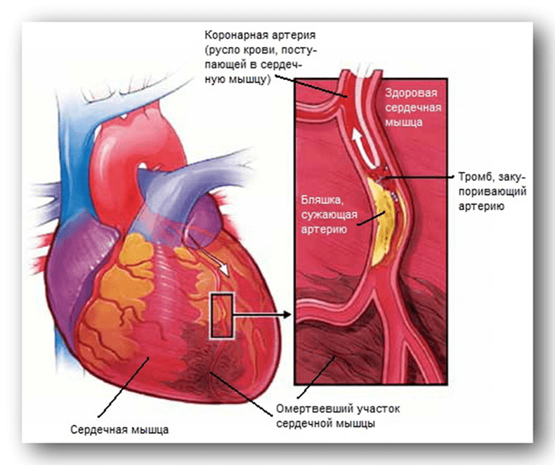 Опасность пристеночного тромбоза сердца и аорты