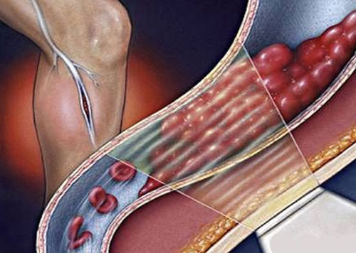 Симптомы и лечение тромбофлебита верхних конечностей