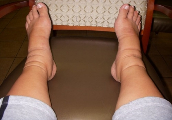 Особенности боли в ногах при варикозном расширении вен