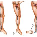 Расширение вен на ногах у подростков лечение thumbnail
