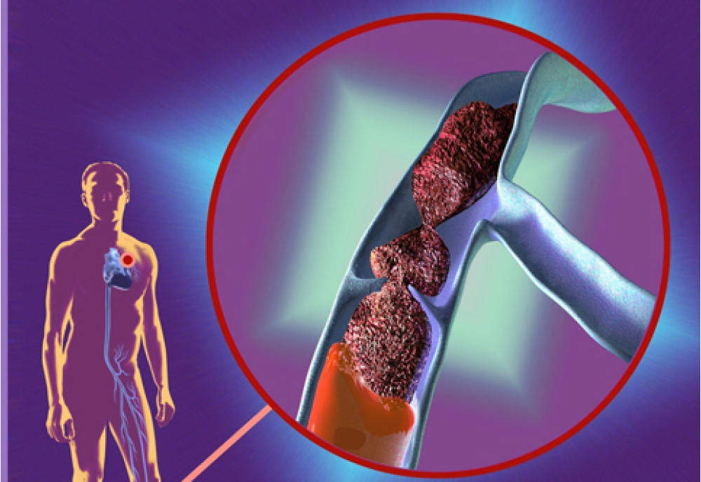 Профилактика лечения тромбов