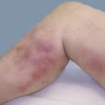 Способы борьбы с варикозом на ногах