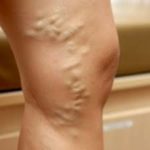 Боль сосудов в ногах лечение в домашних условиях thumbnail
