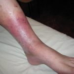 Способы борьбы с варикозом на ногах