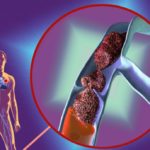 Посттромбофлебитическая болезнь вен нижних конечностей: лечение