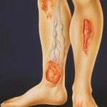 Как лечить трофические язвы на ногах при варикозе в домашних условиях?