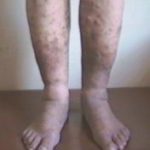 Как называются болезни вен на ногах?