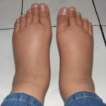 Причины отеков ног у мужчин в области щиколотки и ступни