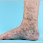 Лечение варикоза стопы ног thumbnail