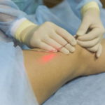 Лазерное лечение сосудистых звездочек на ногах отзывы thumbnail