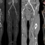 Рентген вен нижних конечностей и ангиография сосудов ног