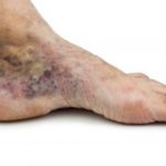 Лечение при варикозе стопы ноги thumbnail