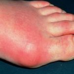 Как снять воспаление вен при варикозе на ноге?