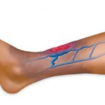 Варикозное расширение вен на ногах: симптомы и лечение, фото