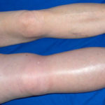 Синдром труссо мигрирующий тромбоз периферических вен thumbnail