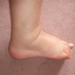 Причины отеков ног у мужчин в области щиколотки и ступни