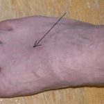 Как снять воспаление вен при варикозе на ноге?