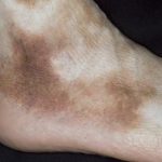 Что такое гиперпигментация кожи на ногах: причины и лечение