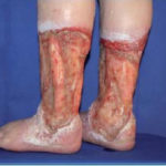 Лечение и профилактика варикоза на ногах