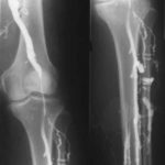 Варикозное расширение глубоких вен на ногах лечение thumbnail