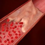 Тромбозы и эмболии артерий: основные виды заболеваний