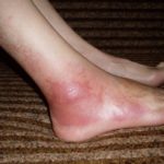 Отек и покраснение ноги при варикозе: что делать и как лечить?