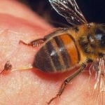 Лечение варикоза вен на ногах укусами пчел