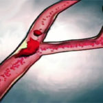 Тромбозы и эмболии артерий: основные виды заболеваний