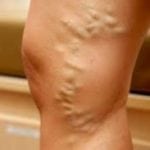 Диагностика ног методы лечения thumbnail