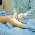 Лазерная флебэктомия: отзывы после операции