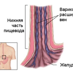 Лечение варикоза вен пищевода при циррозе печени