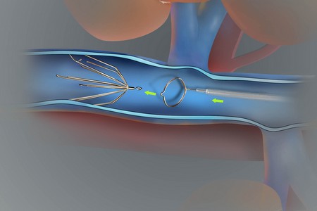 Особенности реканализации глубоких вен нижних конечностей у больных с тромбозом при пролонгированном лечении сулодексидом