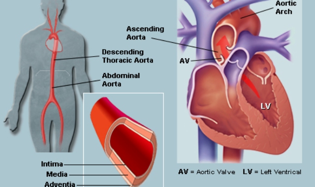 Тромбоэмболия бедренной артерии