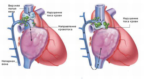 Причины и методы лечения тромбоза нижней полой вены